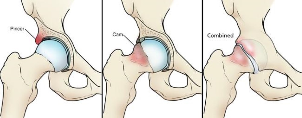 Femoroacetabular Impingement Anatomy